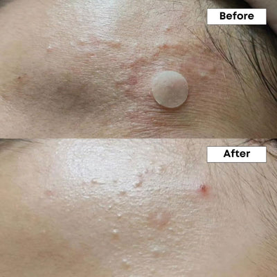 NINELESS A-Control 10% Azelaic Acid Serum 30ml