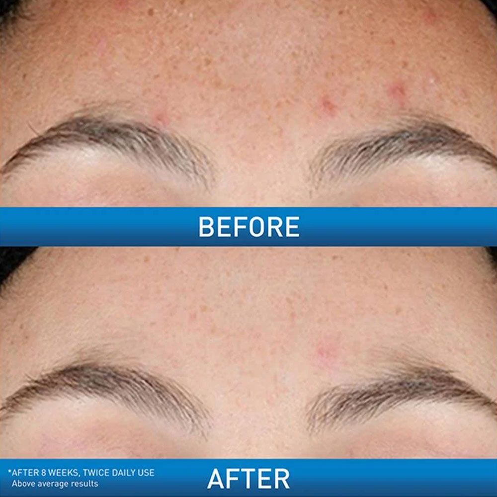 CeraVe Resurfacing Retinol Serum 30ml | Reduce Acne Marks & Uneven Skin Tone