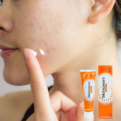Skinoren Cream 30g (Imported) | Anti-acne Treatment